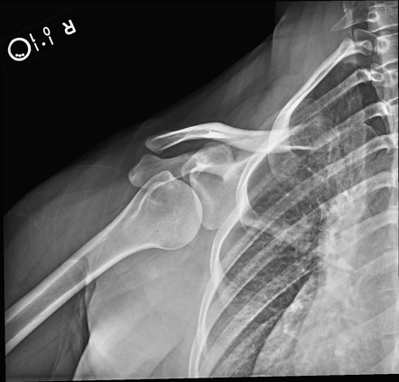 Pectoralis major tendon to scapula transfer | Image | Radiopaedia.org