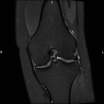 icd 10 code for right knee medial meniscus bucket handle tear