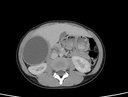 Hepatic hydatid cysts | Radiology Case | Radiopaedia.org