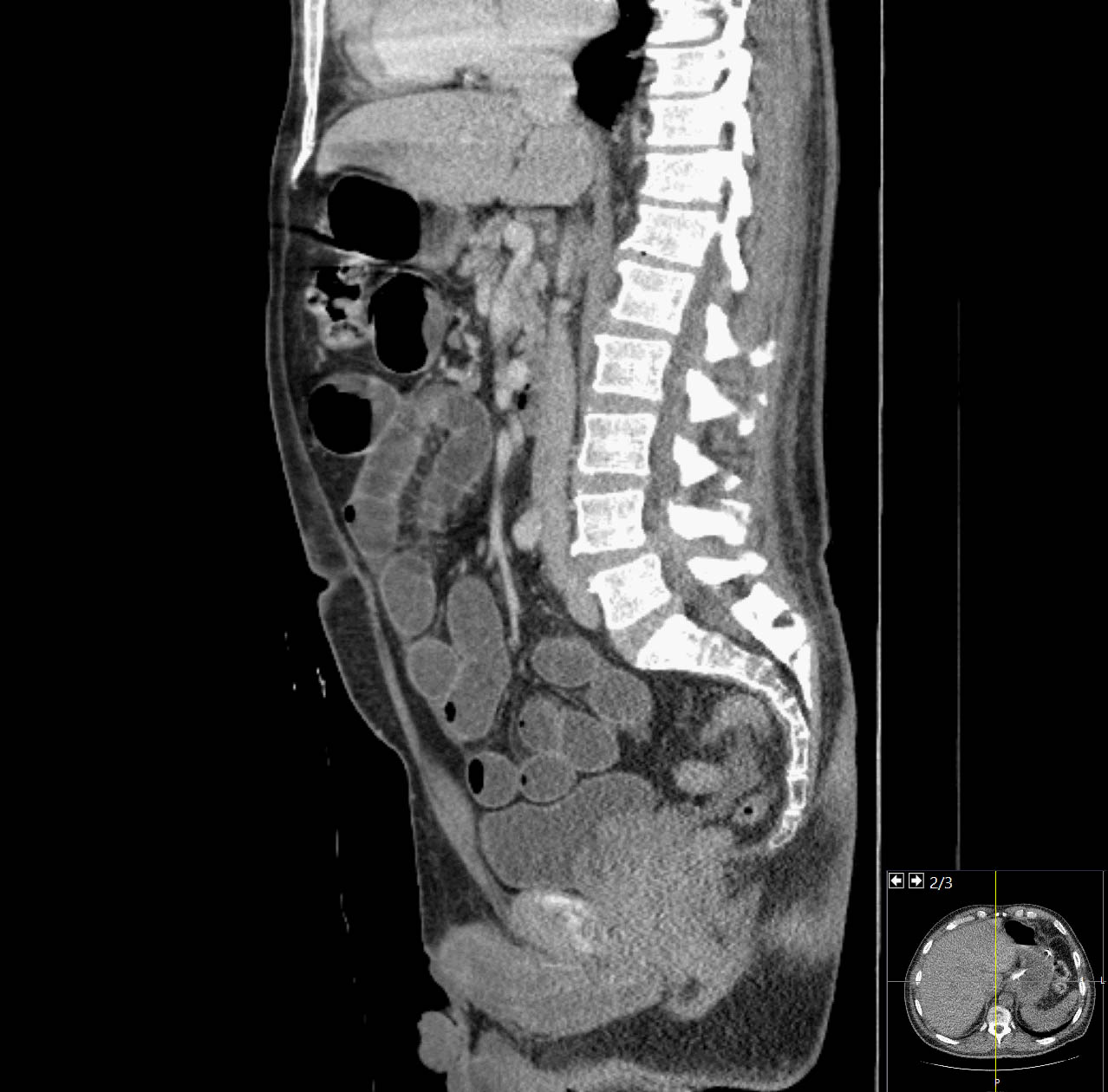 Large Bowel Obstruction Due To Colon Cancer Image 6387