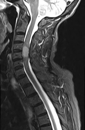 Spinal schwannoma | Image | Radiopaedia.org