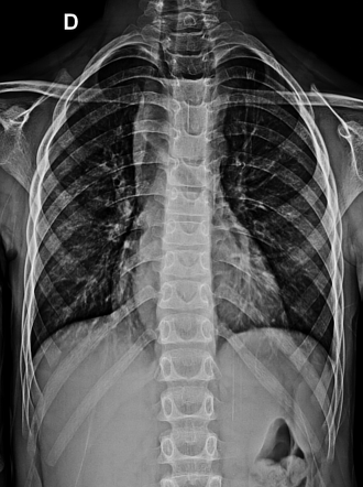 Achalasia - pediatric | Image | Radiopaedia.org