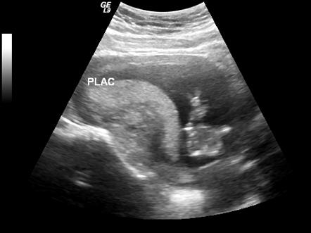 Placental abruption | Radiology Reference Article | Radiopaedia.org