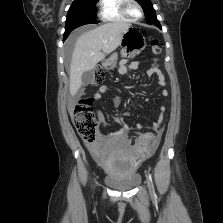 Ruptured ectopic pregnancy | Radiology Case | Radiopaedia.org