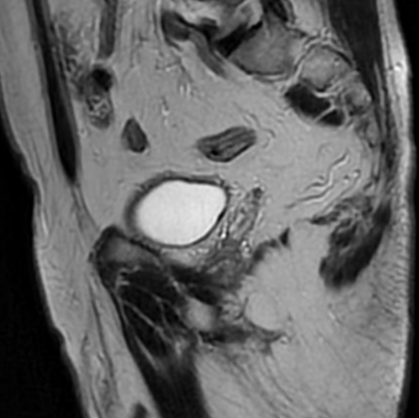 Prostate nodule - PI-RADS 5 | Image | Radiopaedia.org