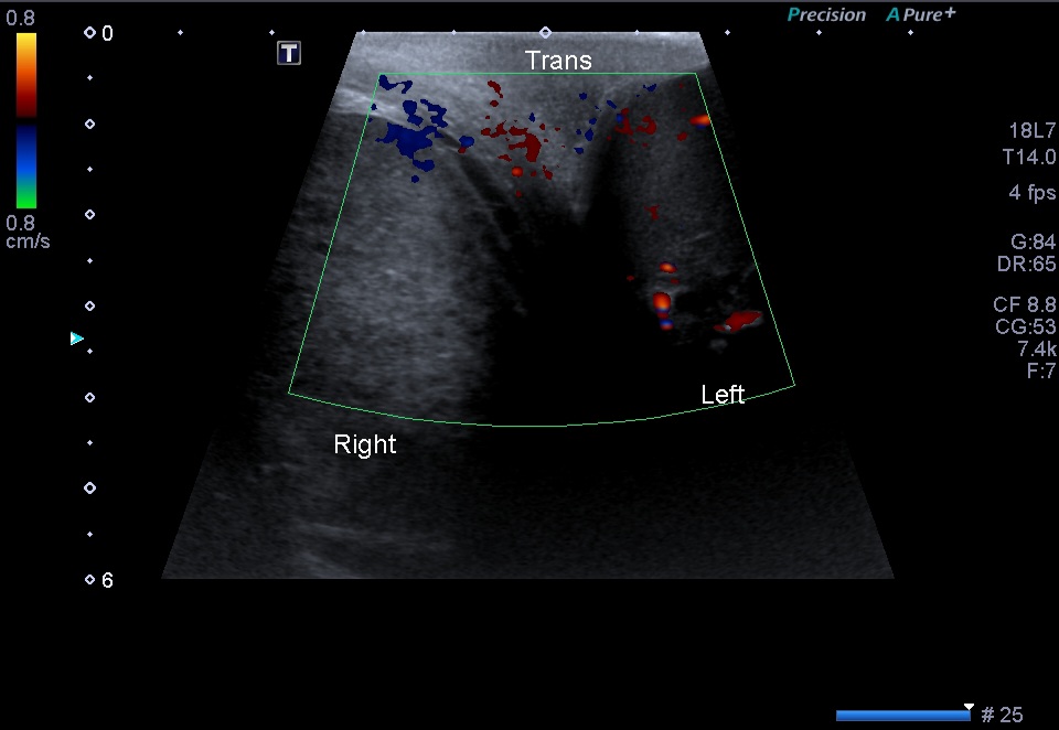 Testicular Infarction Secondary To Epididymo Orchitis Image