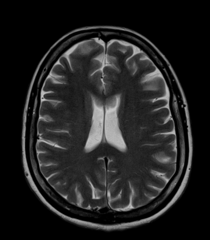 Multiple System Atrophy (cerebellar Type, MSA-C) | Image | Radiopaedia.org