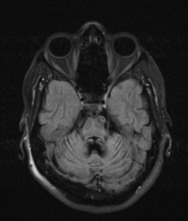 Multiple System Atrophy (cerebellar Type, MSA-C) | Image | Radiopaedia.org