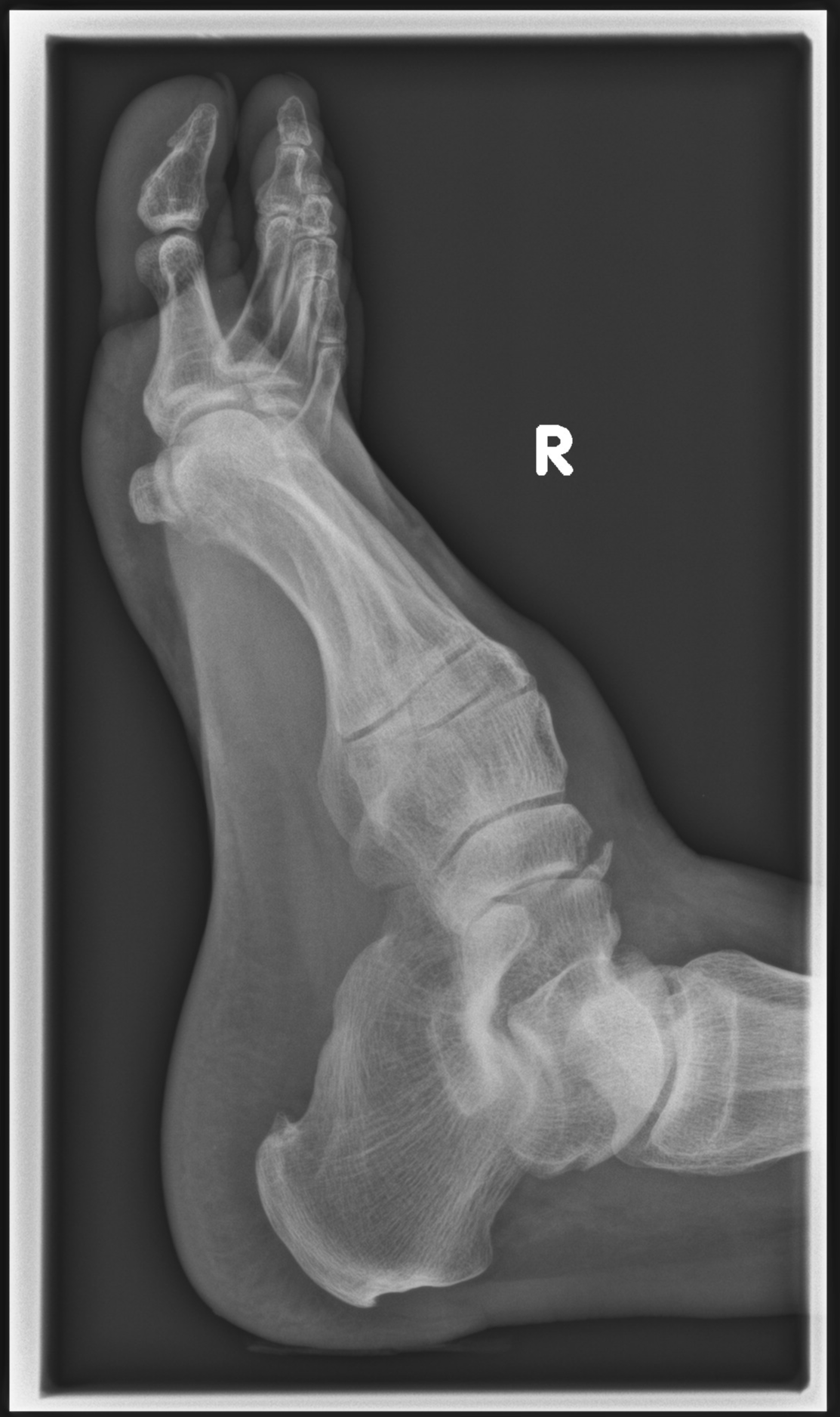 Navicular fracture | Image | Radiopaedia.org