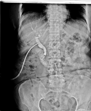 T tube cholangiogram | Radiology Reference Article | Radiopaedia.org