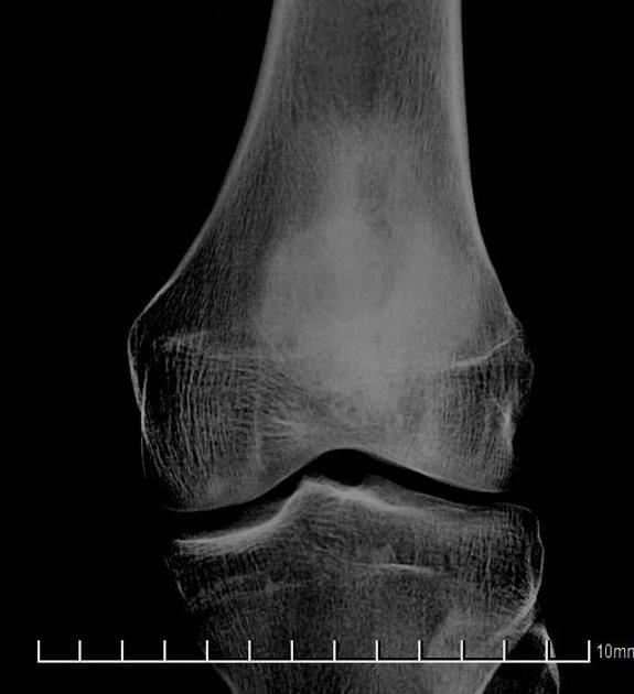 Brodie abscess Radiology Reference Article Radiopaedia