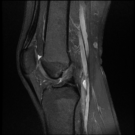 Anterior cruciate ligament tear | Radiology Case | Radiopaedia.org