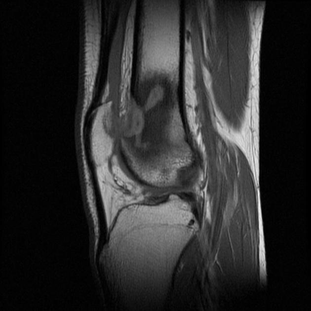 Brodie abscess Radiology Reference Article Radiopaedia