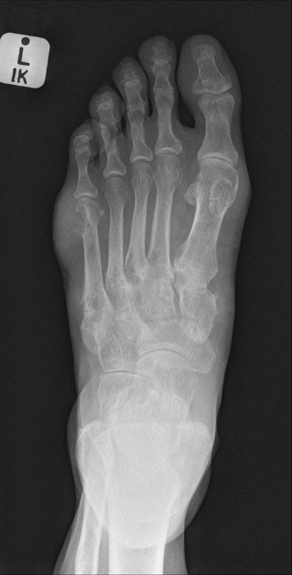 gout xray