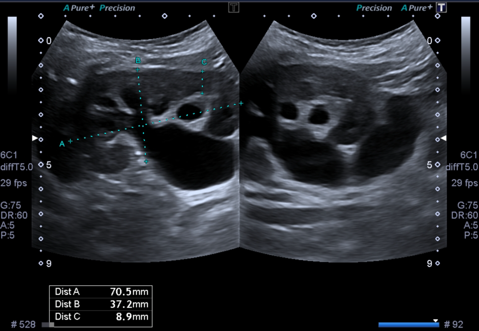 Primary obstructed megaureters | Image | Radiopaedia.org