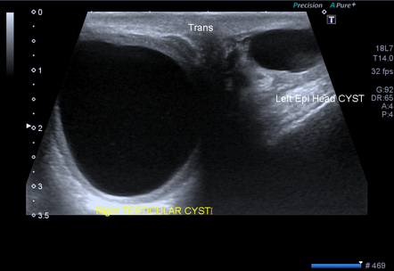 Intratesticular spermatocele | Image | Radiopaedia.org