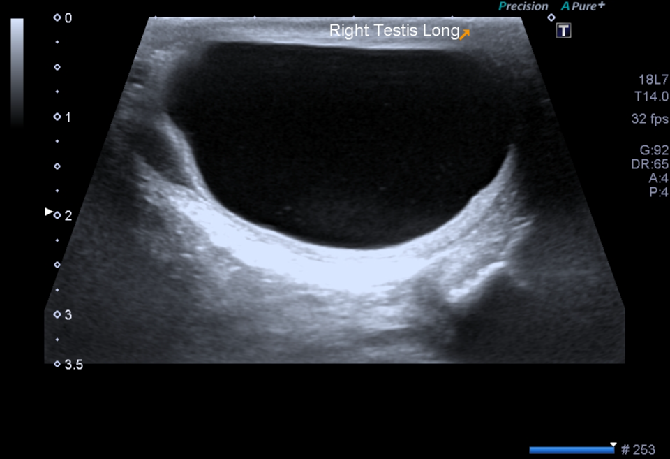 Intratesticular spermatocele | Image | Radiopaedia.org