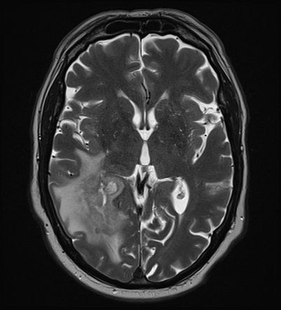 Glioblastoma IDH-wildtype - multifocal | Radiology Case | Radiopaedia.org