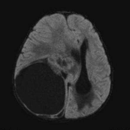 Embryonal tumor with multilayered rosettes | Image | Radiopaedia.org