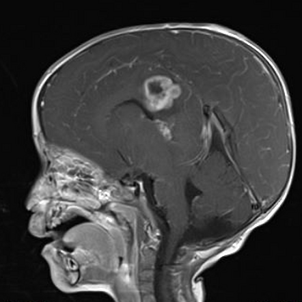 Embryonal tumor with multilayered rosettes | Image | Radiopaedia.org