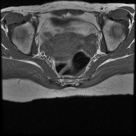 Sacral fracture | Image | Radiopaedia.org