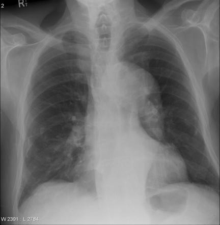 Ectatic thoracic aorta | Radiology Case | Radiopaedia.org