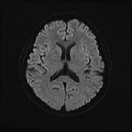 Bilateral lateral semicircular canal–vestibule dysplasia | Image ...