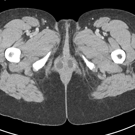 Bartholin glands | Image | Radiopaedia.org