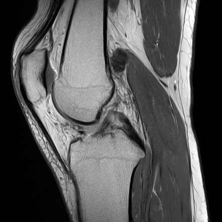 Localized tenosynovial giant cell tumor - knee | Image | Radiopaedia.org