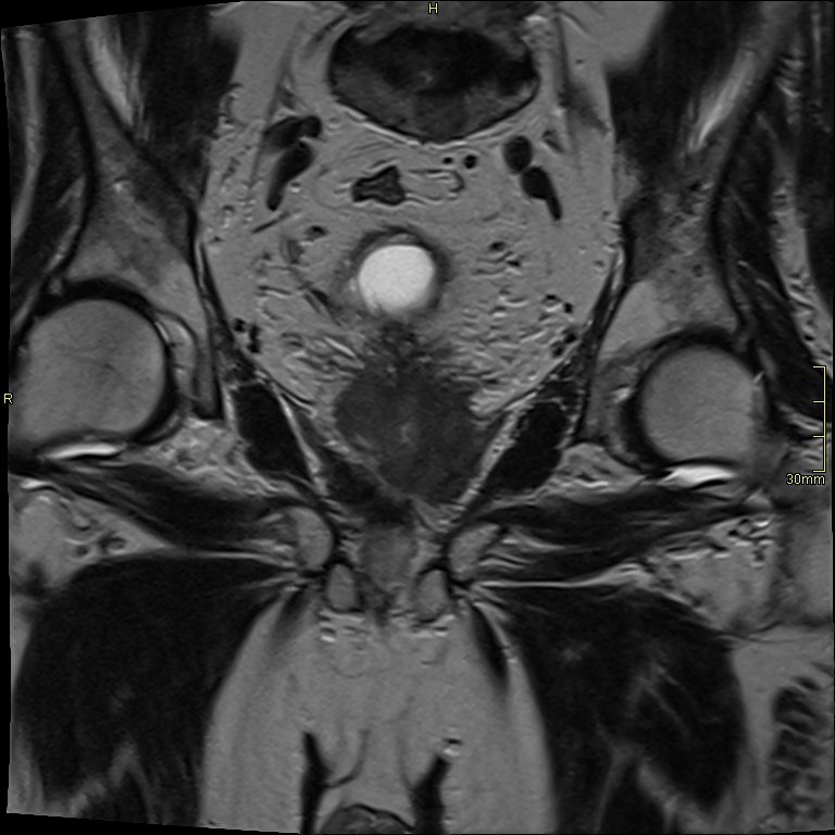 Prostate cancer - T4 rectal invasion | Image | Radiopaedia.org