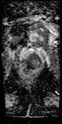 Prostate cancer - T4 rectal invasion | Image | Radiopaedia.org