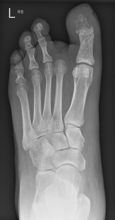 osteomyelitis of left hallux icd 10