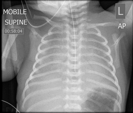 Adhesive atelectasis | Radiology Reference Article | Radiopaedia.org