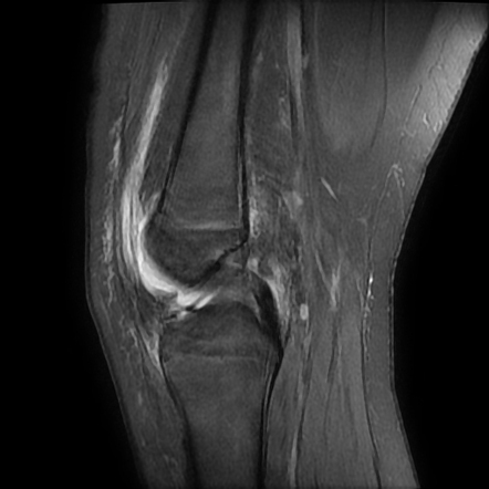 Osteochondral knee fracture and Medial patellofemoral ligament injury ...