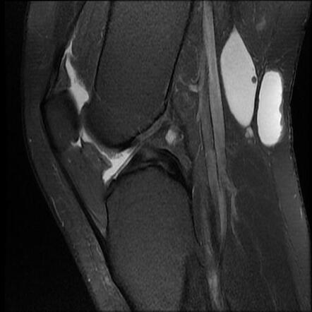 Multiple hereditary exostoses - knee joint | Image | Radiopaedia.org