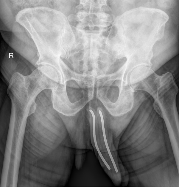 Penile implant Radiology Reference Article Radiopaedia