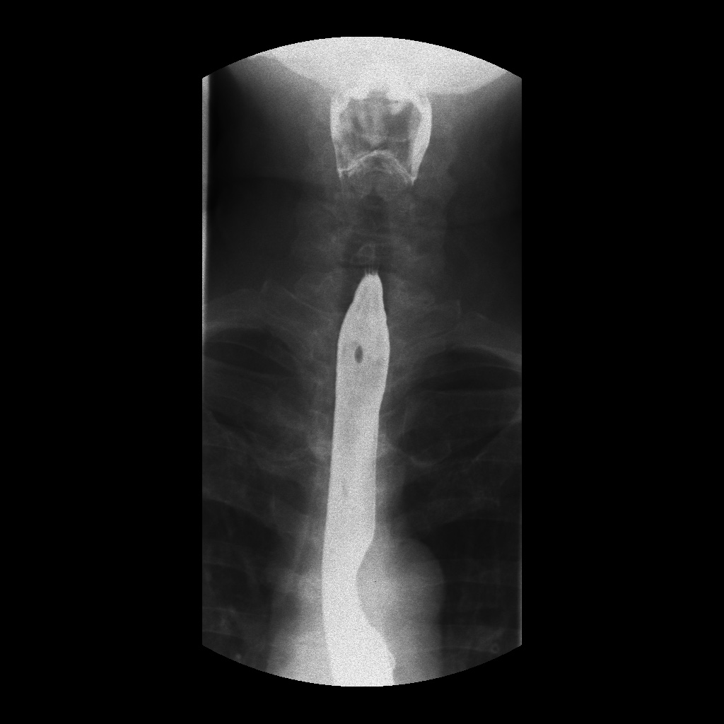 Esophageal cancer (barium swallow) | Image | Radiopaedia.org