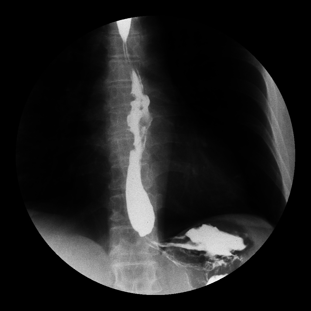 Esophageal cancer (barium swallow) Image