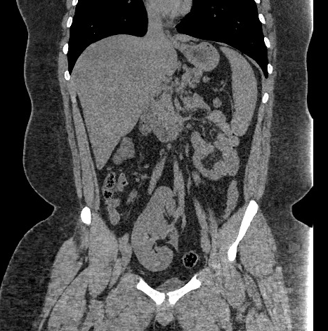 Pancake kidney | Image | Radiopaedia.org