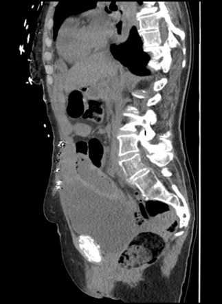 Ischemic SBO from Morgagni hernia | Image | Radiopaedia.org