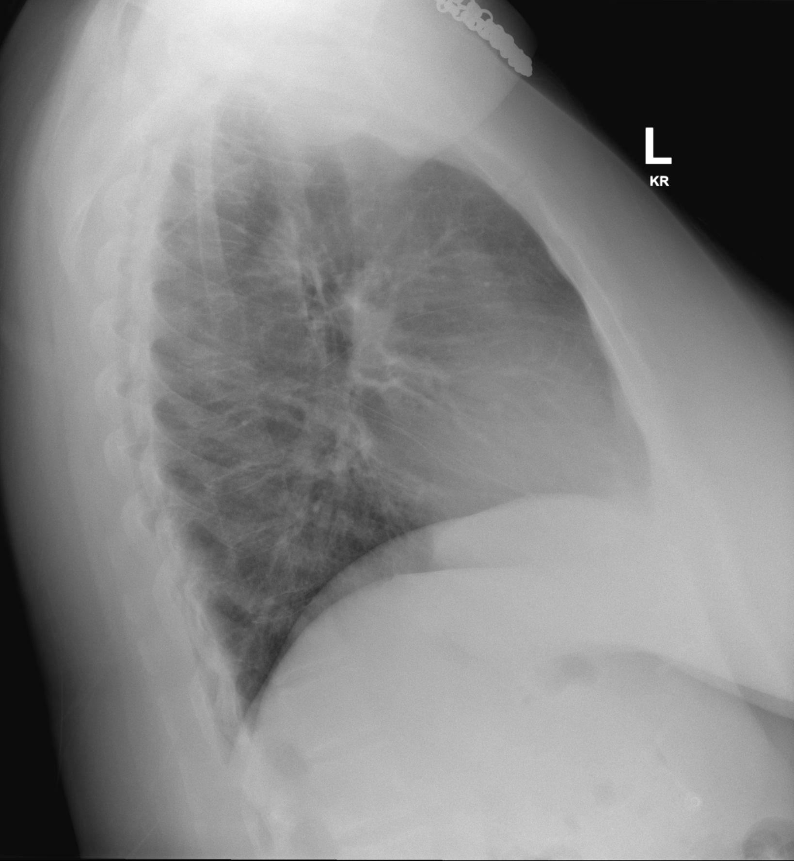 Tracheal Narrowing And Deviation From Goiter On CXR Image Radiopaedia Org