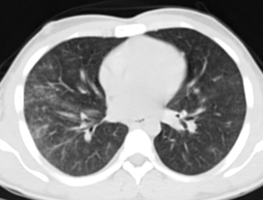 Acute eosinophilic lung disease secondary to drug reaction | Image ...