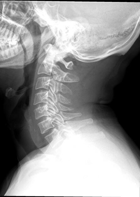 Craniometaphyseal dysplasia radiology