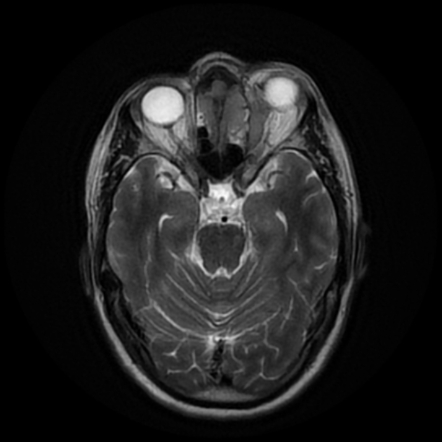 Sinonasal meningioma | Image | Radiopaedia.org