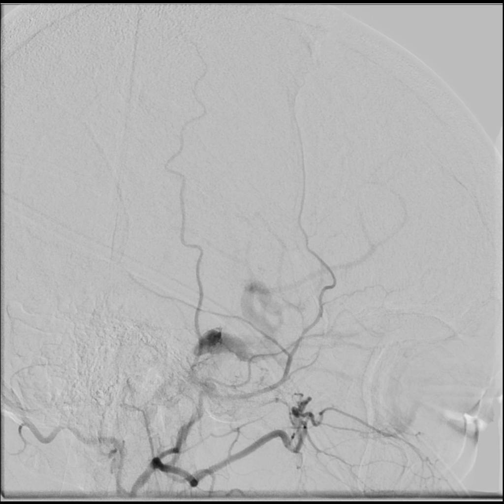 Bilateral indirect carotid cavernous fistula | Image | Radiopaedia.org