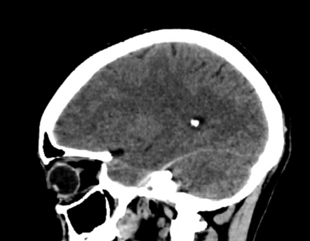 Cerebral hemorrhagic contusions and subdural hematoma | Image ...