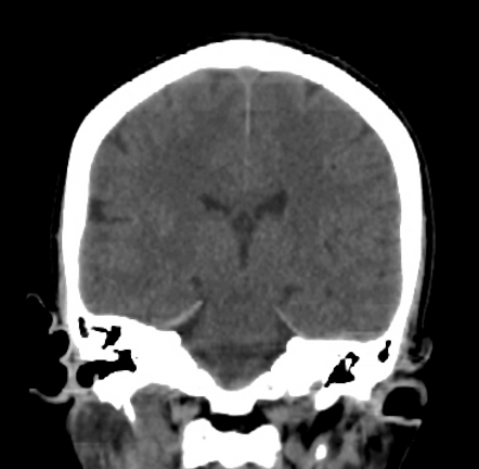 Cerebral hemorrhagic contusions and subdural hematoma | Image ...