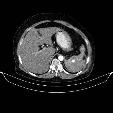 Splenic injury - AAST grade IV | Radiology Case | Radiopaedia.org