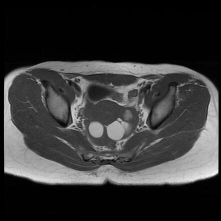 Ovarian endometriomas - bilateral | Radiology Case | Radiopaedia.org