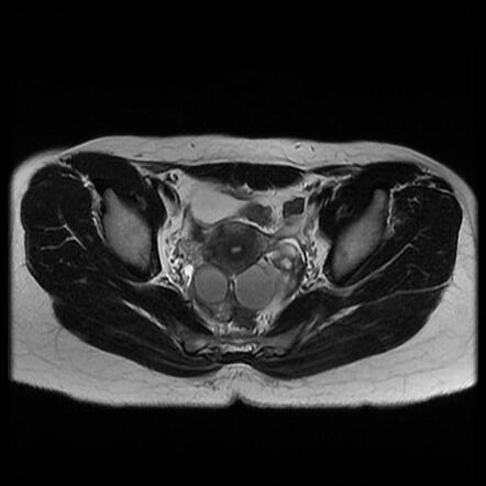 Ovarian endometriomas - bilateral | Image | Radiopaedia.org